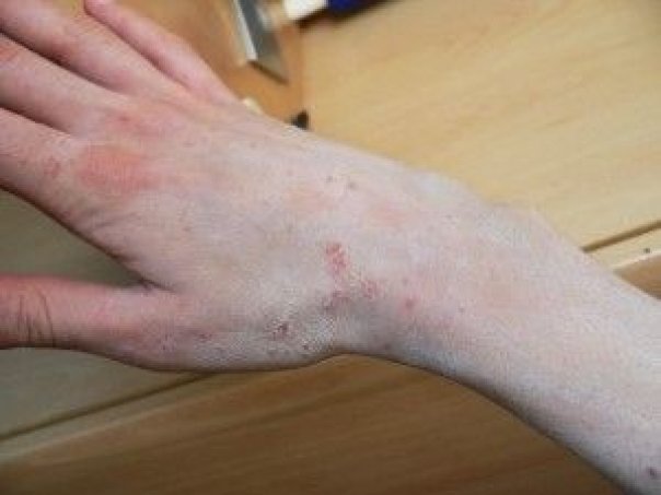 Anchetă la DGASPC Gorj. Mai mulți beneficiari ai centrului din Vădeni, diagnosticați cu scabie