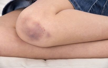 Plină de vânătăi pe picioare! Suspectul?! Tatăl său 